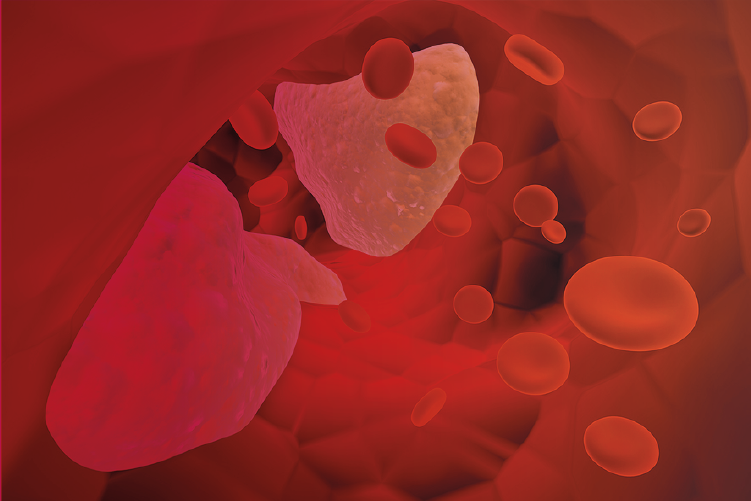 Diplomatura: Aterosclerosis y Cardiometabolismo